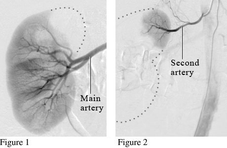 Angiogram image of arterial supply to left kidney