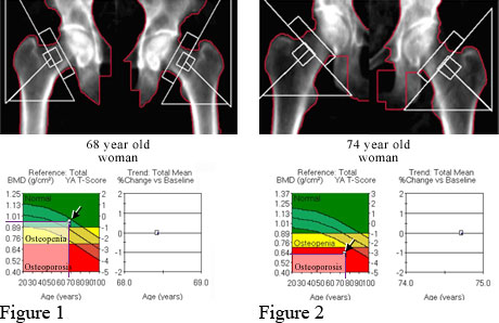 DXA of osteoporosis