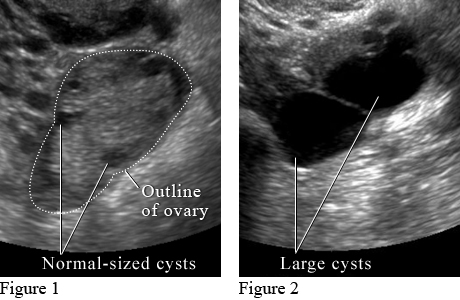 Ultrasound images of ovarian cysts.