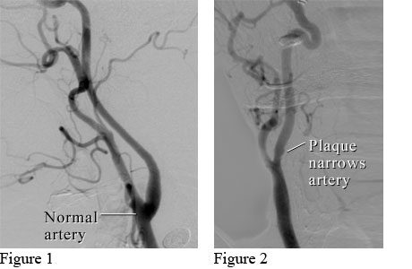 Angiograms of a normal neck artery and a neck artery narrowed by plaque.