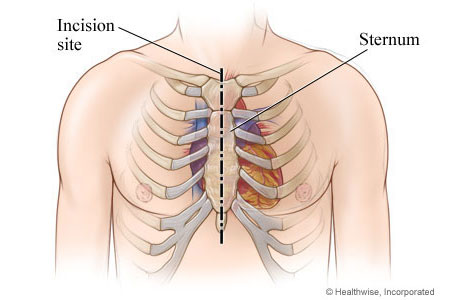 Location of incision in chest.