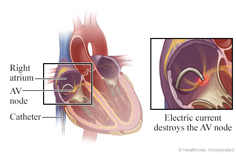 Location of catheter in the heart with detail of electric current destroying AV node