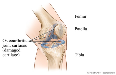 Knee joint with osteoarthritis.