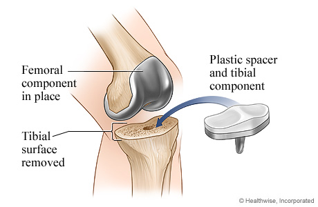 Knee replacement surgery: Tibial component.