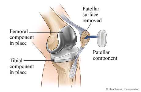 Knee replacement surgery: Patellar component.