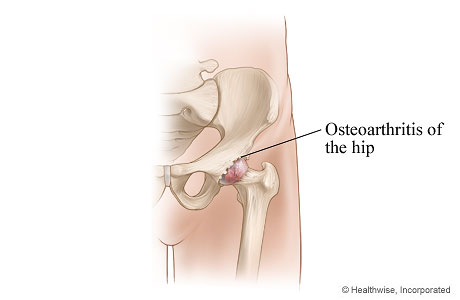 Hip joint affected by osteoarthritis.
