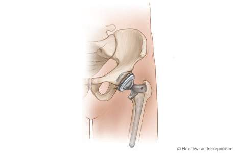 Completed hip replacement