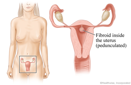 Location of uterus and ovaries, with detail of fibroid growing on inner wall of uterus.