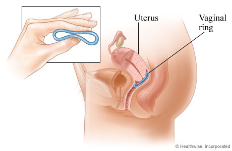 Vaginal ring method of birth control