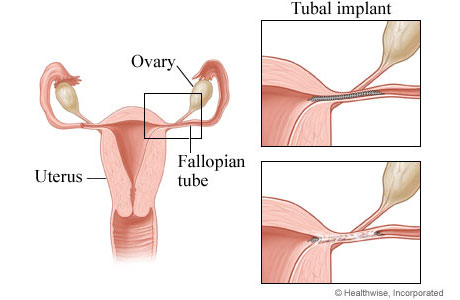 Fallopian tubes between uterus and ovaries, with detail of fallopian tube showing tubal implant and scar tissue.