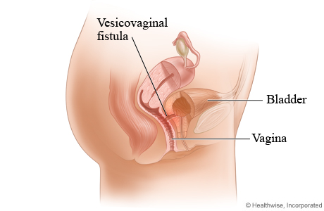 Vesicovaginal fistula.