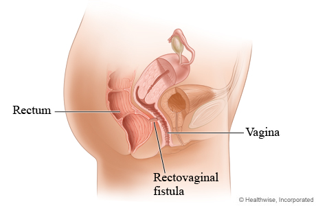 Rectovaginal fistula