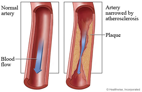 Normal artery and blood flow and an artery narrowed by atherosclerosis.