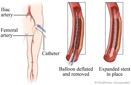 Deflated balloon removed and expanded stent in place.