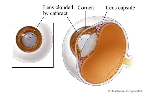 Lens of the eye clouded by a cataract.