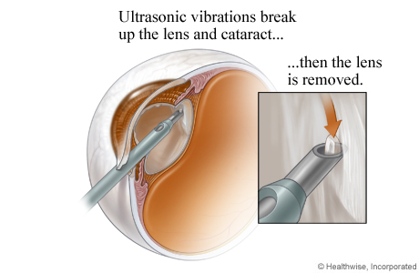Cataract being broken up using ultrasound and removed using suction.
