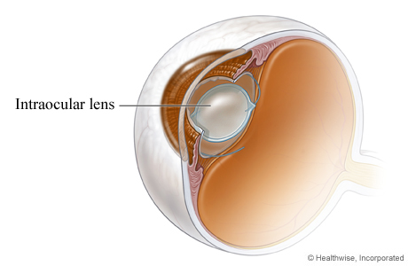 An intraocular lens in place after cataract surgery.