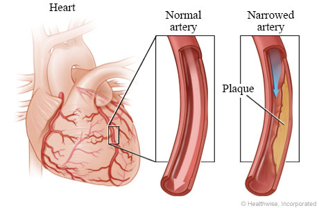 Normal coronary artery and artery narrowed by plaque.