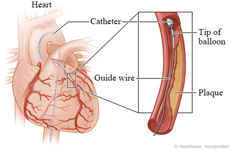 Guide wire and tip of balloon in narrowed artery.