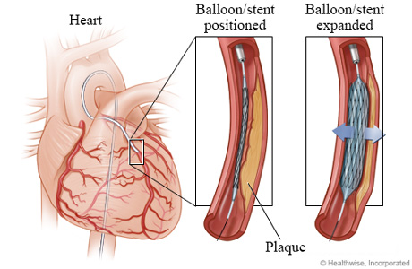 Balloon and stent positioned and expanded.