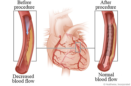 Decreased blood flow caused by narrowed artery before angioplasty compared to normal blood flow after angioplasty.