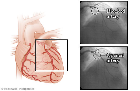 Arteries before and after an angioplasty.