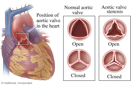 Location of aortic valve in heart with detail of normal open and closed valve and one with stenosis.