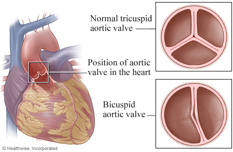 Location of aortic valve in heart, with details of a tricuspid valve and a bicuspid valve.