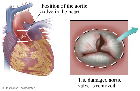 Location of aortic valve in the heart with detail of damaged valve.