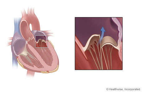 Location of mitral valve in the heart and detail of mitral valve regurgitation.