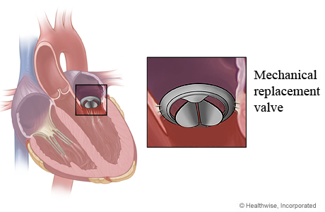 Mechanical mitral valve in heart and close-up of mechanical replacement valve.