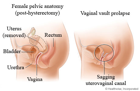 Vaginal vault prolapse