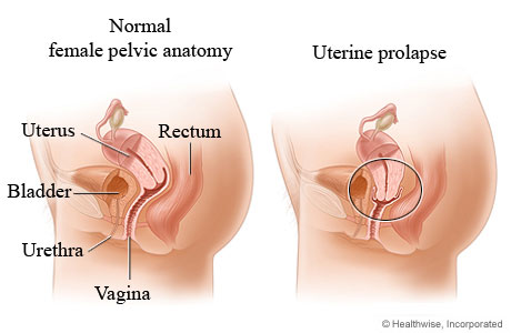 Uterine prolapse.