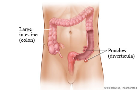Pouches (diverticula) in the large intestine (colon).