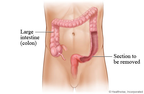 Colostomy surgery for IBD  IBDrelief