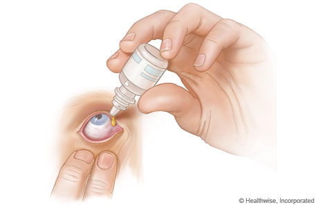 How to put eyedrops in the eye.