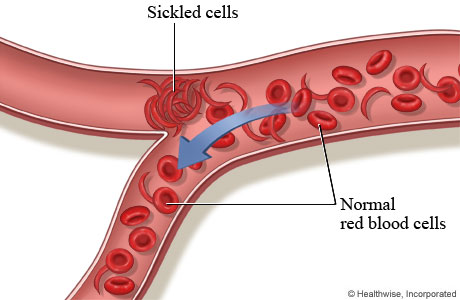 Sickled cells blocking a blood vessel.