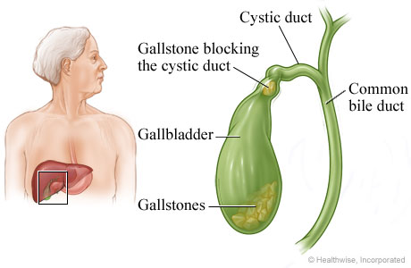 Gallbladder and gallstones.