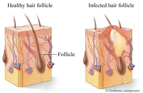 A healthy hair follicle and an infected hair follicle
