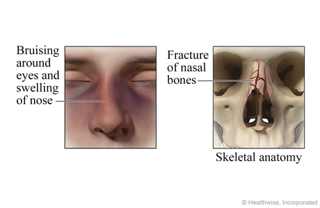 Broken nose.