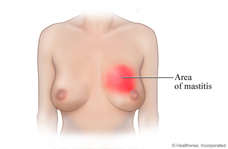 Mastitis (inflammation of the breast)