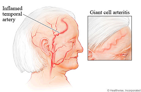 Giant cell arteritis.