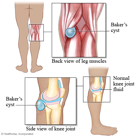 Baker's cyst.