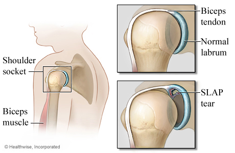 One type of shoulder SLAP tear