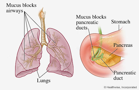 Organs most frequently affected by cystic fibrosis (lungs and pancreas).