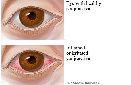 Healthy conjunctiva compared to conjunctivitis (pink eye).