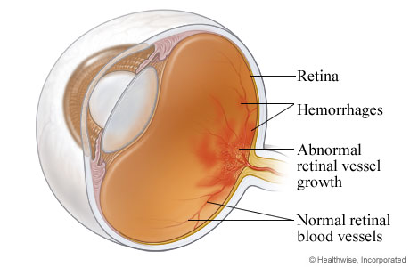 Diabetic retinopathy.