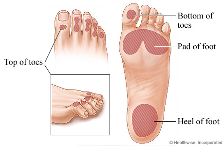 Common locations of foot ulcers.