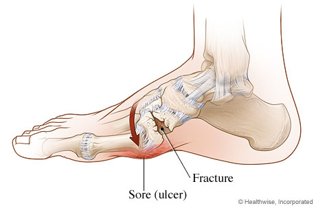 Picture of Charcot foot.