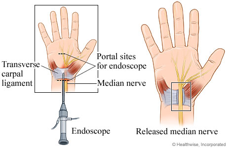 Endoscopic carpal tunnel release surgery.